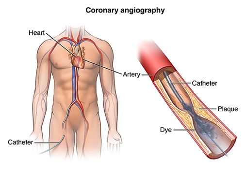 Angiography Catheter Market: Size, Share, CAGR of 10.6% Growth, Analysis, and Report 2023-2032