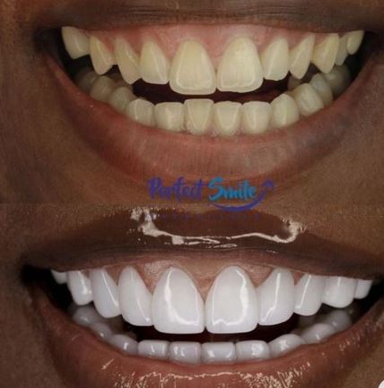 Unveiling the Secrets of Dark Gums: Transformative Solutions by BriteGums