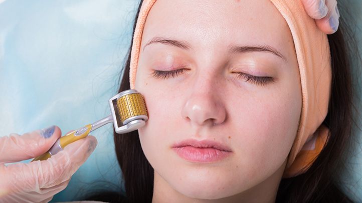 Why Choose Microneedling in Houston at Queen Aesthetics?