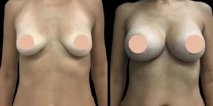 Before and after image of a female breast lift