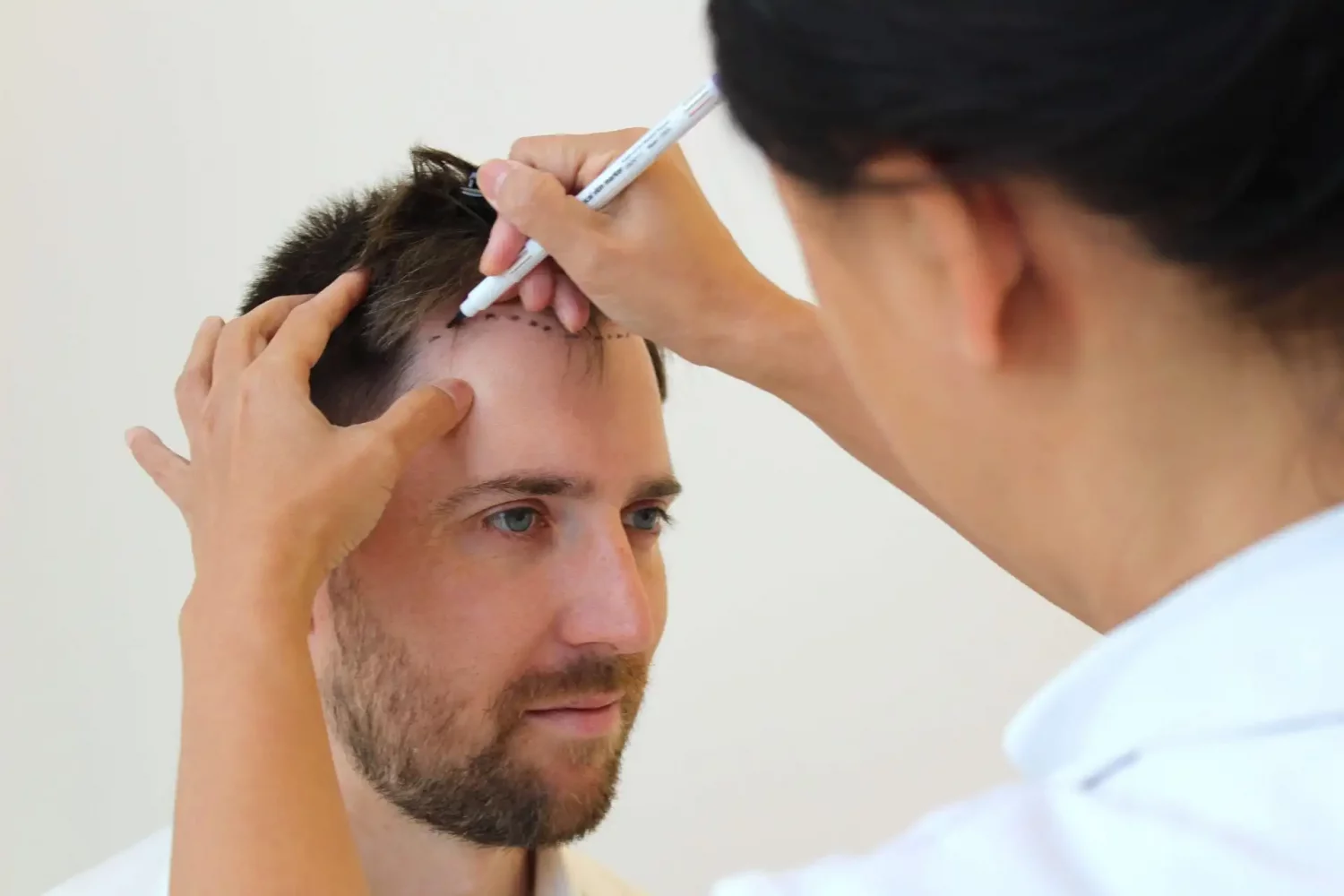 Experience the Best FUE Hair Transplant in London: Patient Guide