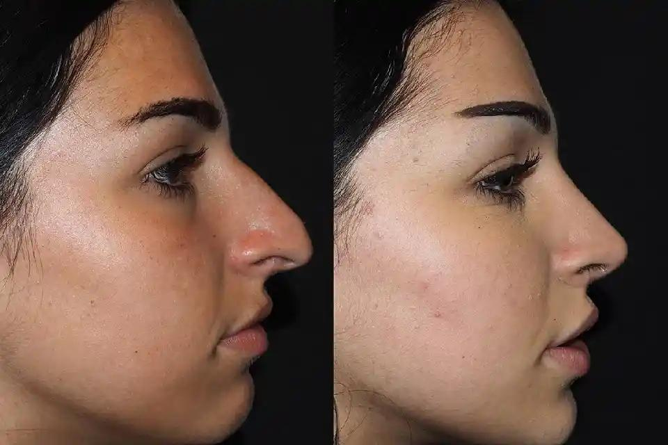 Male Rhinoplasty in Dubai: Enhancing Masculine Features