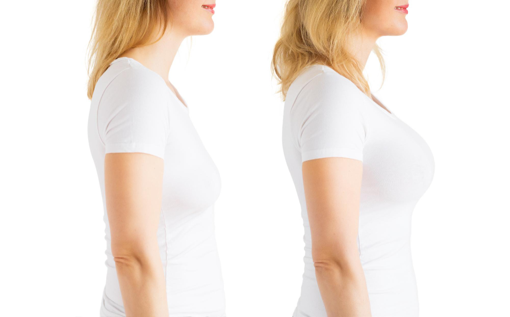 Choosing the Right Breast Lift Technique for Your Needs in Dubai